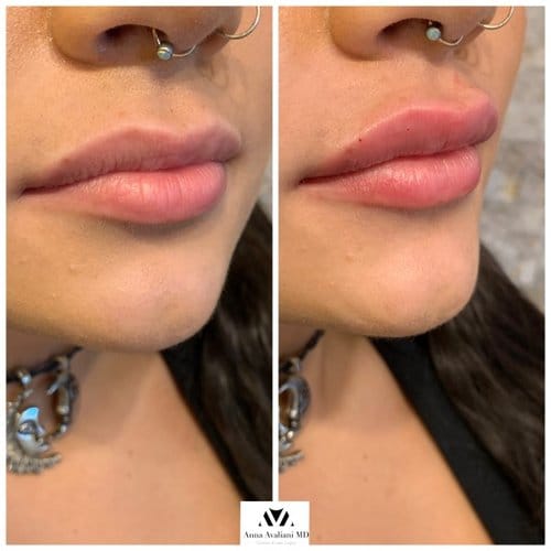 Lip Augmentation before and after, result 2