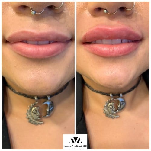 Lip Augmentation before and after, result 3
