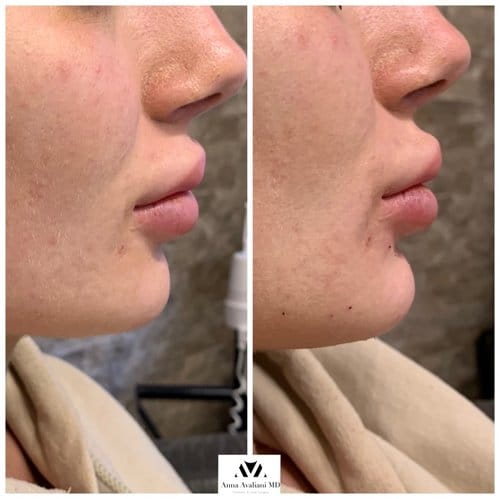 Non Surgical Chin Augmentation before and after
