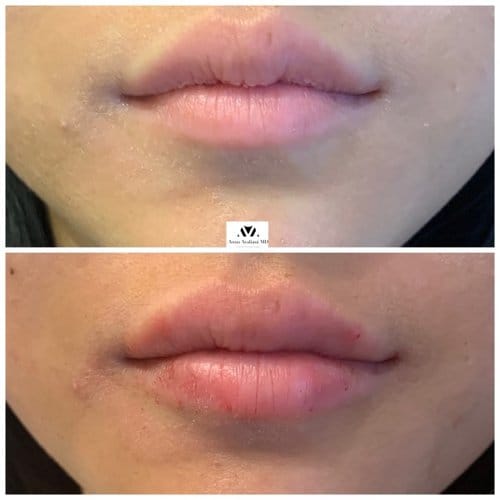 Lip Augmentation before and after, result 4