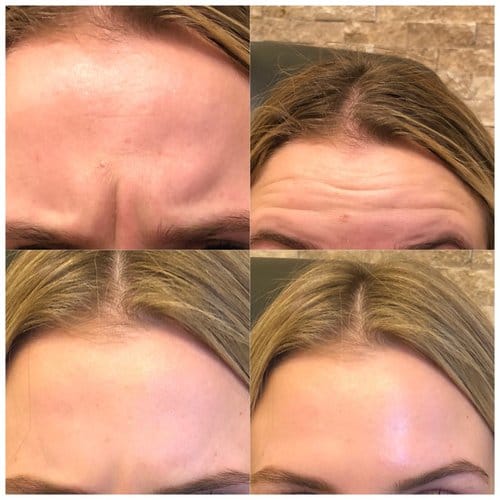 Botox before and after, result 27