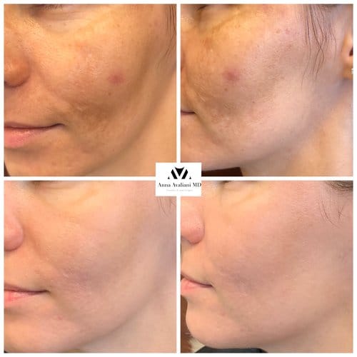 PicoSure / Laser Skin Rejuvenation before and after, result 31