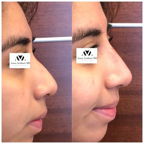 Non Surgical Nose Job before and after, result 21