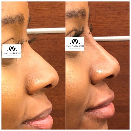 Non Surgical Nose Job before and after, result 22