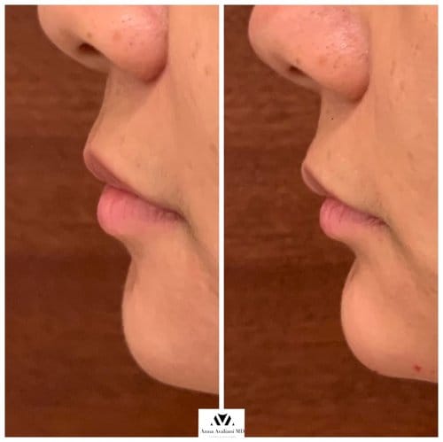 Non Surgical Chin Augmentation before and after, result 3