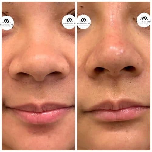 Non Surgical Nose Job before and after, result 1