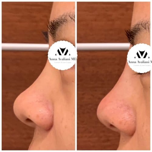 Non Surgical Nose Job before and after, result 2