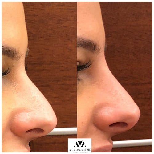 Non Surgical Nose Job before and after, result 23