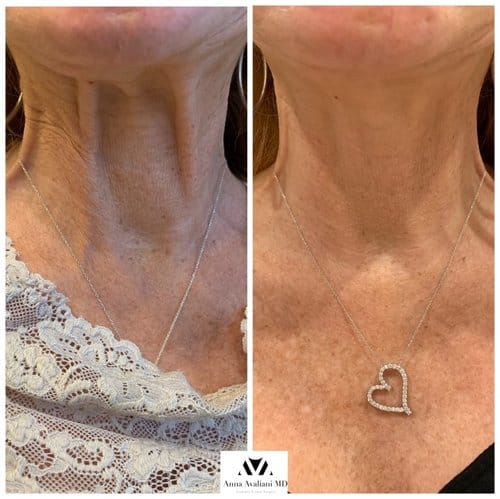 Botox before and after, result 1
