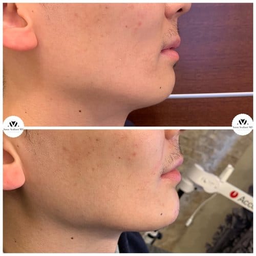 Non Surgical Chin Augmentation before and after, result 4