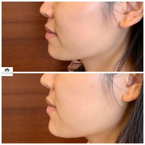 Non Surgical Chin Augmentation before and after, result 5