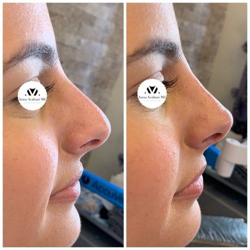 Non Surgical Nose Job before and after, result 3