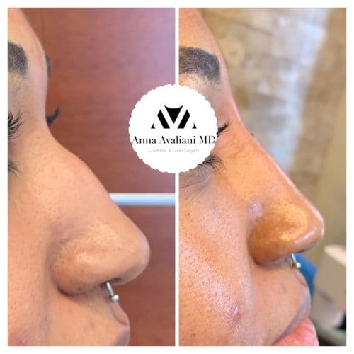 Non Surgical Nose Job before and after, result 4