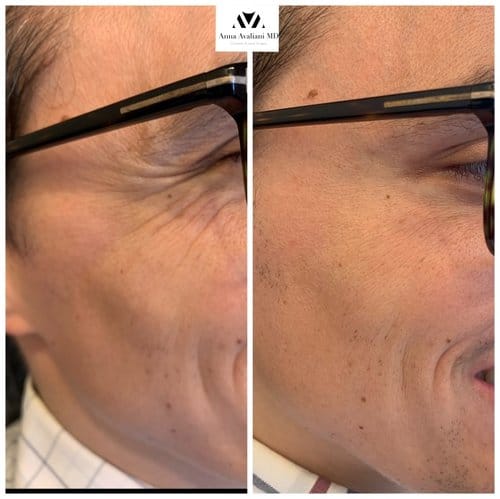Botox before and after, result 2