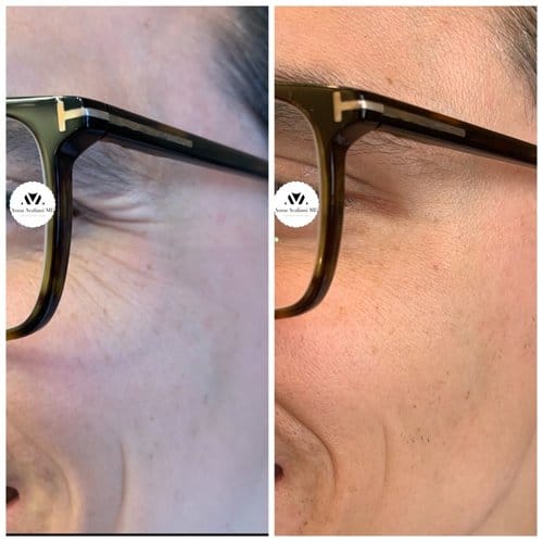 Botox before and after, result 3