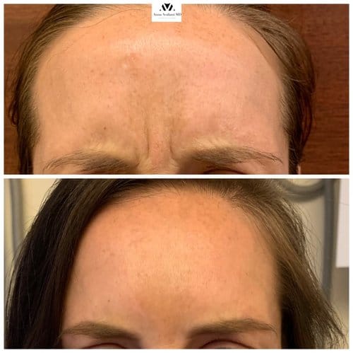 Botox before and after, result 4