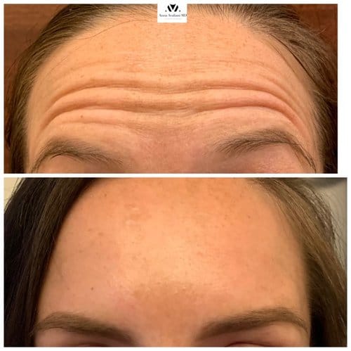 Botox before and after, result 5