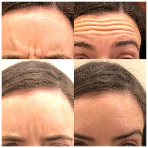 Botox before and after, result 26