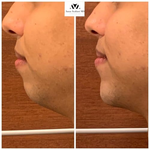 Non Surgical Chin Augmentation before and after, result 6