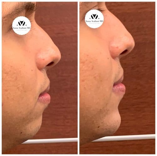 Non Surgical Chin Augmentation before and after, result 7