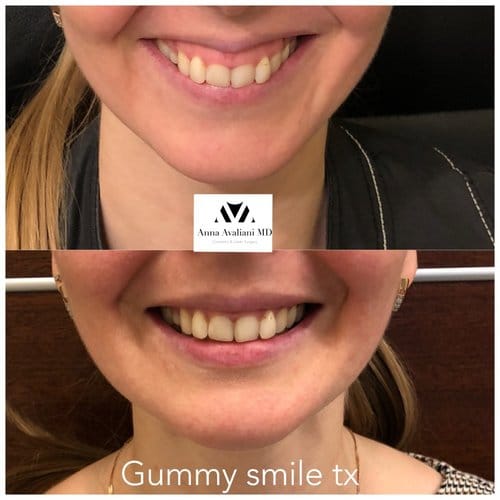 Botox before and after, result 25