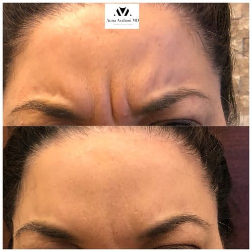 Botox before and after, result 24
