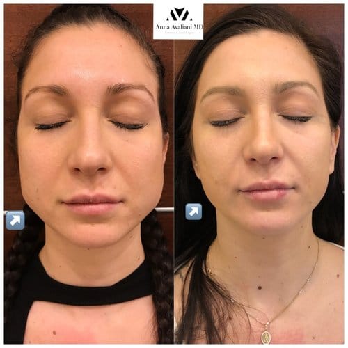 Botox before and after, result 23