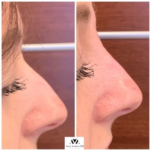Non Surgical Nose Job before and after, result 5