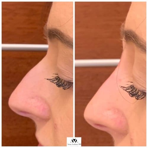 Non Surgical Nose Job before and after, result 6