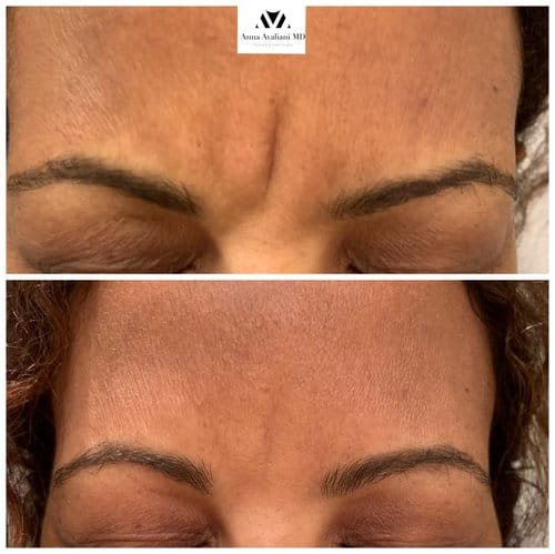 Botox before and after, result 6