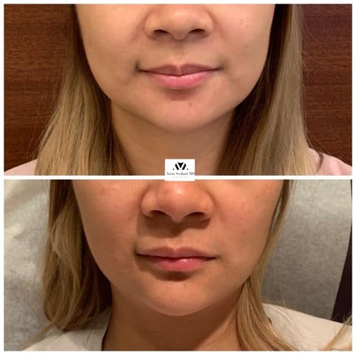 Botox before and after, result 7