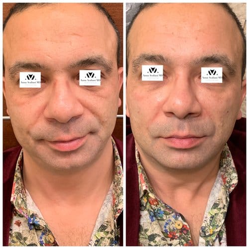 Fillers before and after, result 9