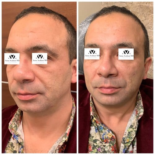 Fillers before and after, result 8