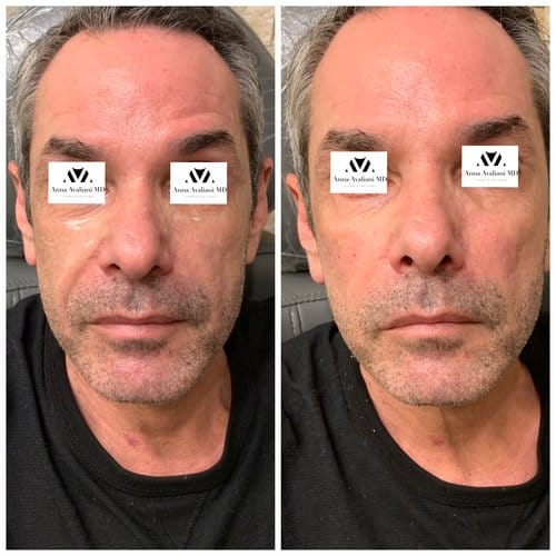 Fillers before and after, result 7