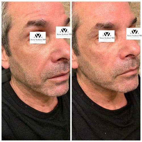 Fillers before and after, result 6