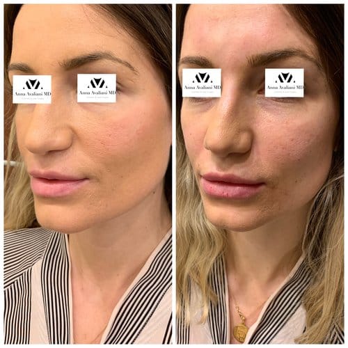 Fillers before and after, result 5