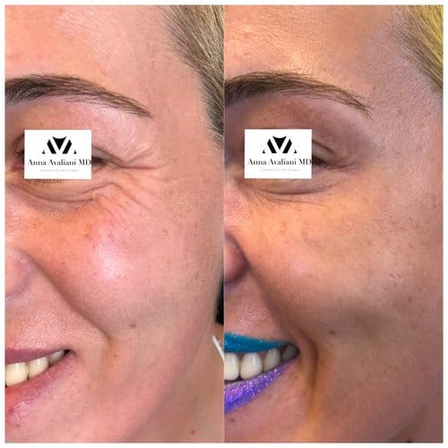 Botox before and after, result 22