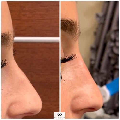 Non Surgical Nose Job before and after, result 7