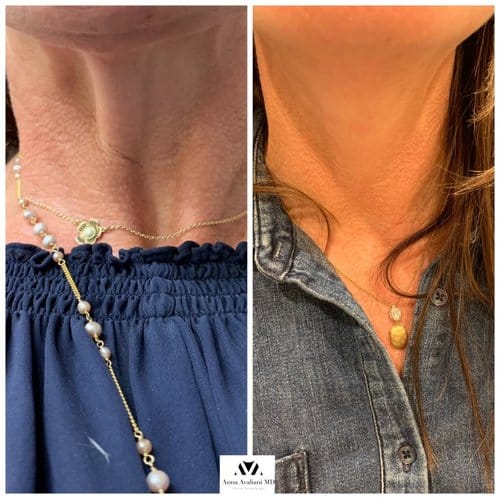 Botox before and after, result 8