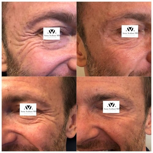 Botox before and after, result 21