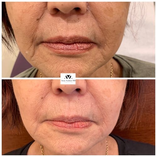 Fillers before and after, result 4