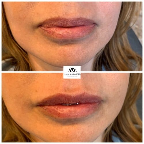 Lip Augmentation before and after, result 5