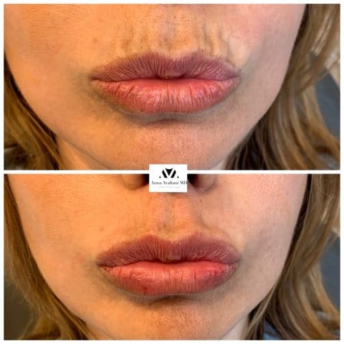 Lip Augmentation before and after, result 6