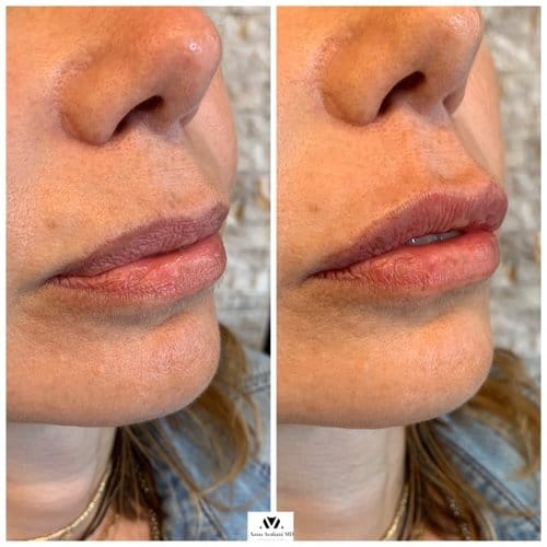 Lip Augmentation before and after, result 7