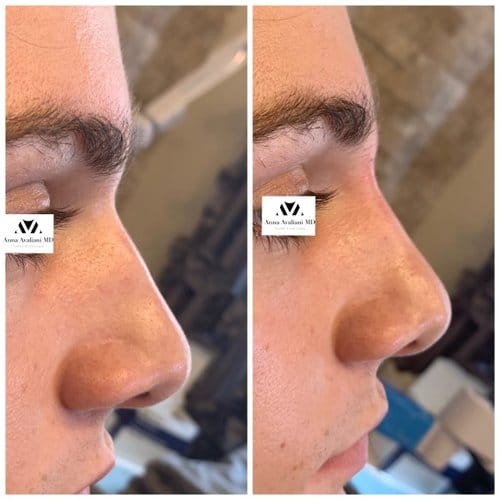 Non Surgical Nose Job before and after, result 8
