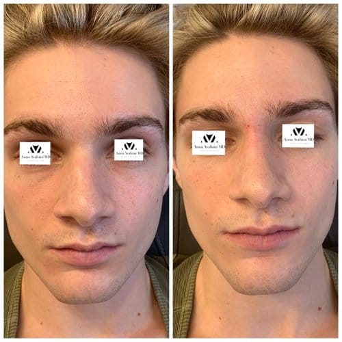 Non Surgical Nose Job before and after, result 9