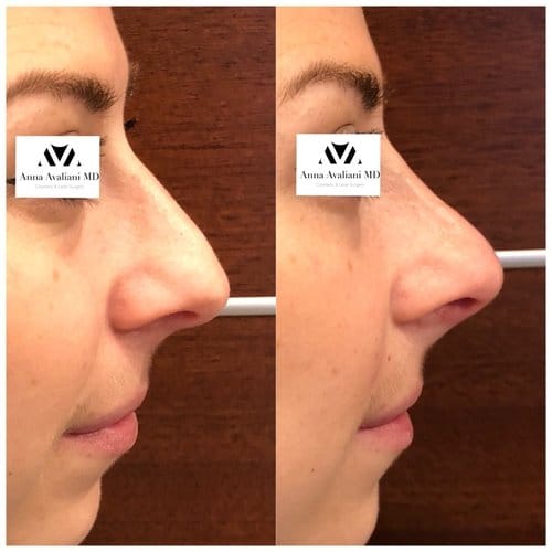 Non Surgical Nose Job before and after, result 24