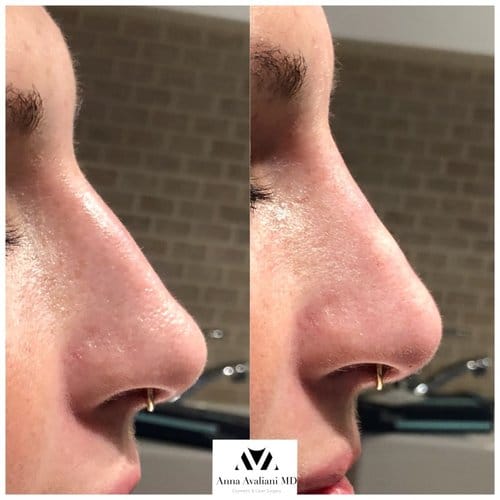 Non Surgical Nose Job before and after, result 25