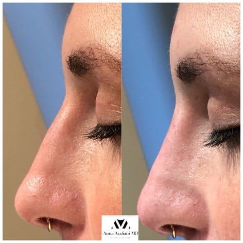 Non Surgical Nose Job before and after, result 20