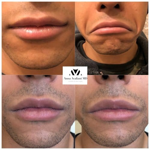 Botox before and after, result 20